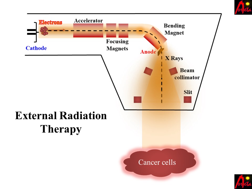 External Radiation Therapy